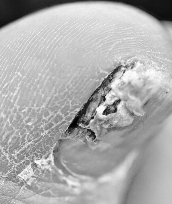 Remedies For Toenail Fungus