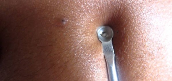 How do I get rid of Blackheads on my nose