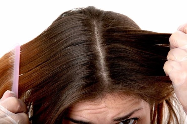 Home Remedies for Dandruff