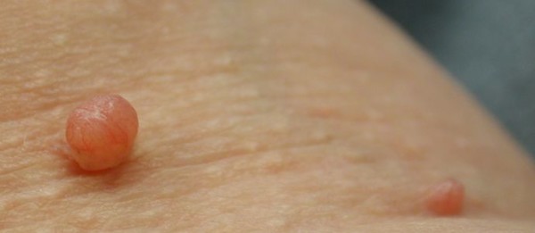How to Remove Skin Tags