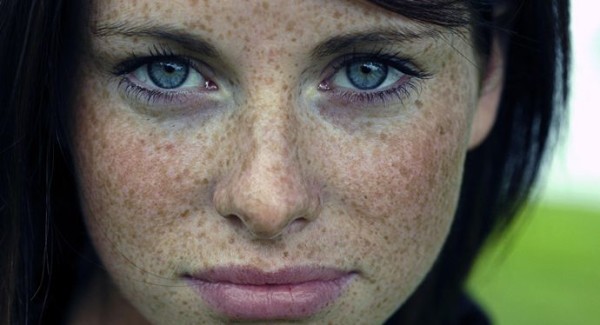 How to Remove Freckles