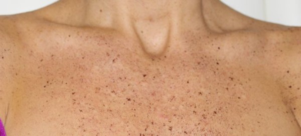 What are Freckles