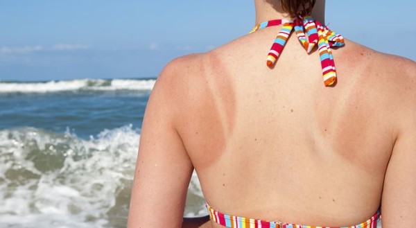 What to do for Sunburn
