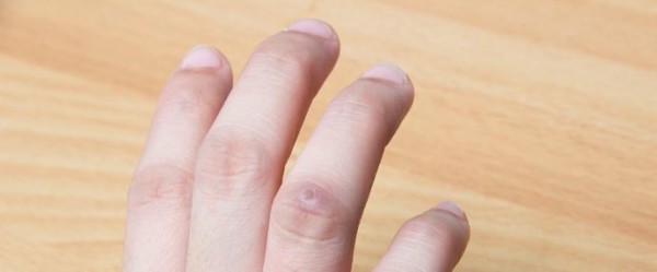 How to Get Rid of Warts