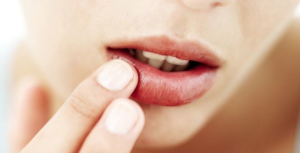 Cold Sore Treatment