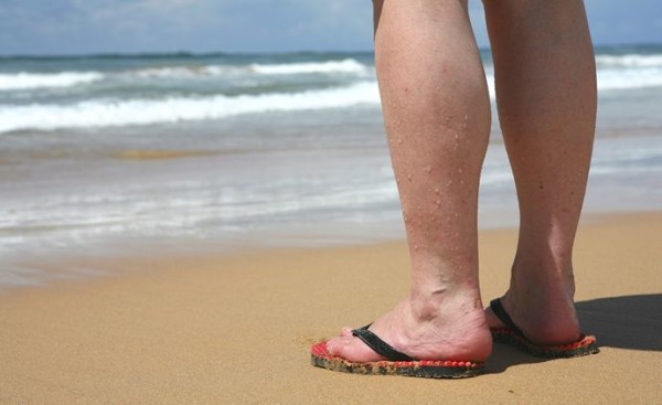 Treatment for Varicose Veins