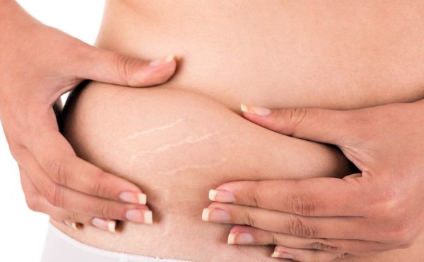 How to Reduce Stretch Marks