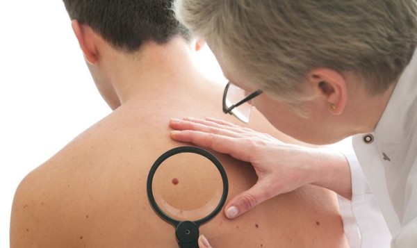 How do you remove moles
