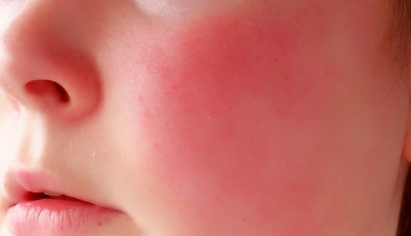 Home remedies for rosacea