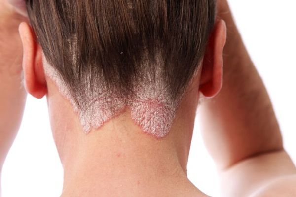 Remedies for Psoriasis